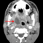 Right peritonsillar abscess (red arrow) with associated mass effect on the right eccentric oropharynx.