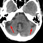 Characteristic appearence of bilateral enlarged horizontal fissures (red arrows) in the setting of cerebellar volume loss.