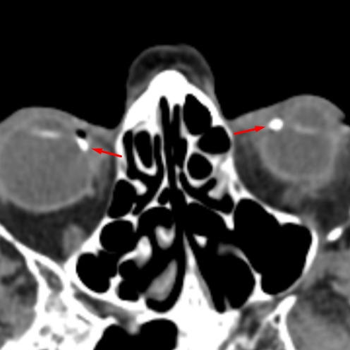 Calcific Scleral Plaques