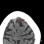 When localizing with the thin axial series, the findings on coronal correlate with a linear cortical vein (red arrows)