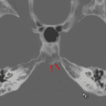 Posteriorly direct bony stalk (red arrows) along the left posterior aspect of the cystic clival lesion.