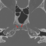 Well-marginated lucent lesion involving the right eccentric and dorsal clivus
