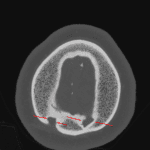 Bilateral enlarged parietal foramina (red arrows)