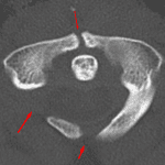 Faiilure of posterior midline and right posterior arch fusion as well as anterior arch fusion (red arrows). Notice the well corticated/smooth margins of the defects.