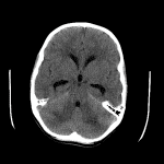Axial CT image shows patchy hypoattenuation in the bilateral cerebellar hemispheres with resultant crowding of the fourth ventricle and obstructive hydrocephalus.