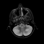 Axial T2-weighted MR image shows hyperintensity in the bilateral cerebellar hemispheric gray and white matter consistent with acute cerebellitis.