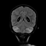 Coronal FLAIR MR image shows patchy hyperintensity in the bilateral cerebellar hemispheric gray and white matter consistent with acute cerebellitis.