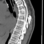 CT myelography confirms the MRI findings, raising primary concern for cord herniation rather than an arachnoid cyst or web.