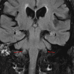 Normal bilateral floculli (red arrows) on subsequent MRI (coronal T2 FLAIR)