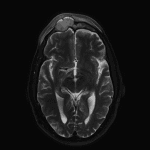 Expansile lesion in the right frontal sinus with low to intermediate T2 signal intensity.