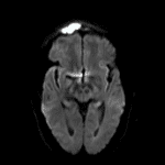Corresponding signal hyperintensity in the DWI sequence.