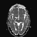 Corresponding signal hypointensity on the ADC map.