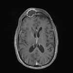 Corresponding peripheral enhancement and subjacent dural thickening and enhancement on postcontrast imaging.