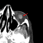 The inferior oblique appears mass-like near it's insertion on the inferolateral globe (red arrow)