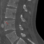 Well-corticated bony fragment involving the anterosuperior vertebral body, compatible with a limbus vertebra.