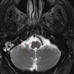 Normal flocullus (red arrow) on subsequent MRI (axial T2)