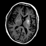 Asymmetric T1 signal hyperintensity in the left putamen, typical for nonketotic hyperglycemic hemichorea-hemiballism.