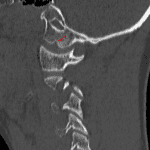 Sagittal CT demonstrates the medial occipital condyle notch (red arrow)