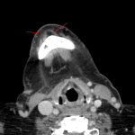 Normal fat anterior to the midline mandible (red arrows).