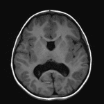 Absent septum pellucidum with fusion of the thalami at midline. Abnormally thickening gyri along the posterior sylvian fissures with polymicrogyria.