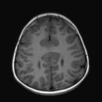 Cross-hemispheric bridging supracallosal gyri with abnormal cortical thickening.