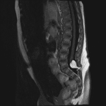Low-lying spinal cord with associated fatty mass extending through a posterior defect in the spinal canal. The neural placode-mass interface is located within the spinal canal, consistent with a lipomyelocele.