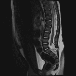 Low-lying spinal cord with associated fatty mass extending through a posterior defect in the spinal canal. The neural placode-mass interface is located within the spinal canal, consistent with a lipomyelocele.