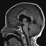 Dysmorphic appearance of the corpus callosum, particularly involving the body and isthmus, with more relatively normal appearance of the genu and splenium.