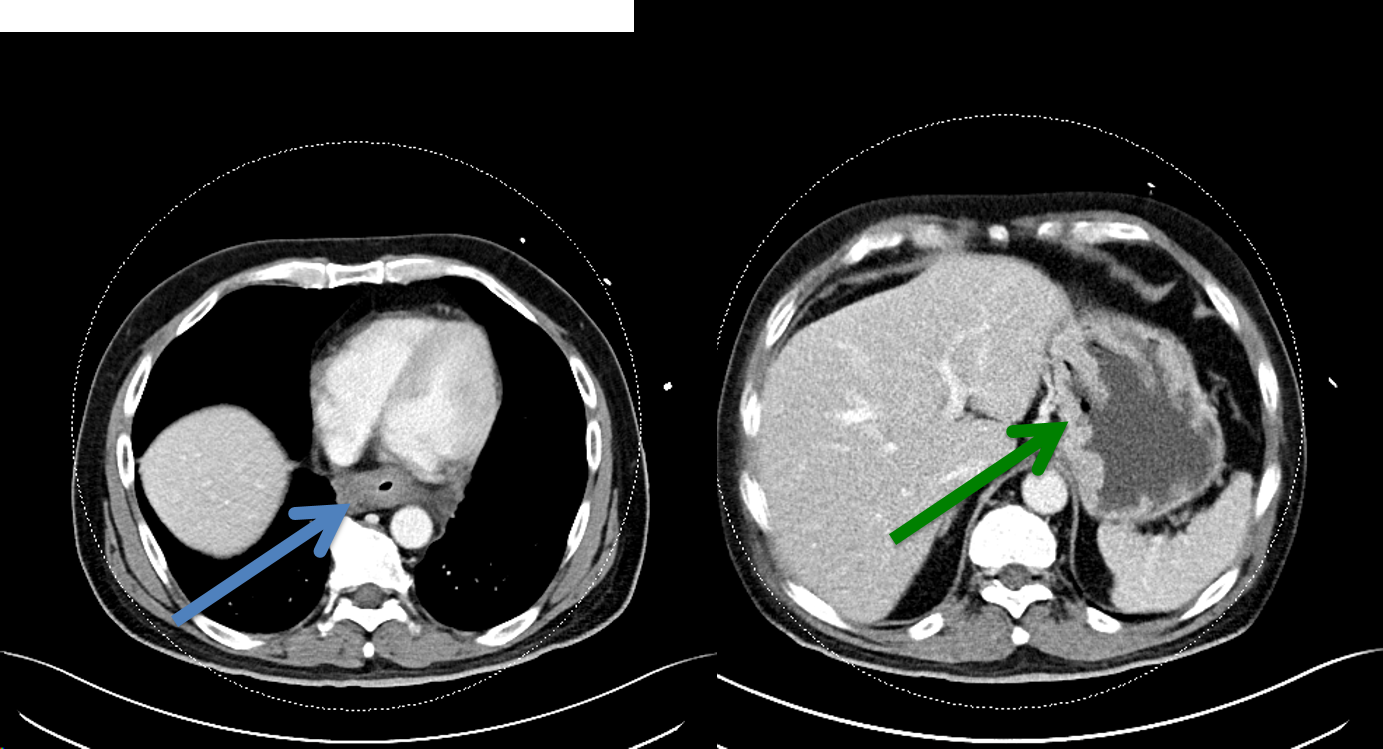 CT shows esophagitis with circumferential esophageal thickening (blue arrow), gastritis with gastric fold thickening (green arrow), along with duodenal hyperemia and ulcers (red arrow). There is a mass in the duodenum (yellow arrow).