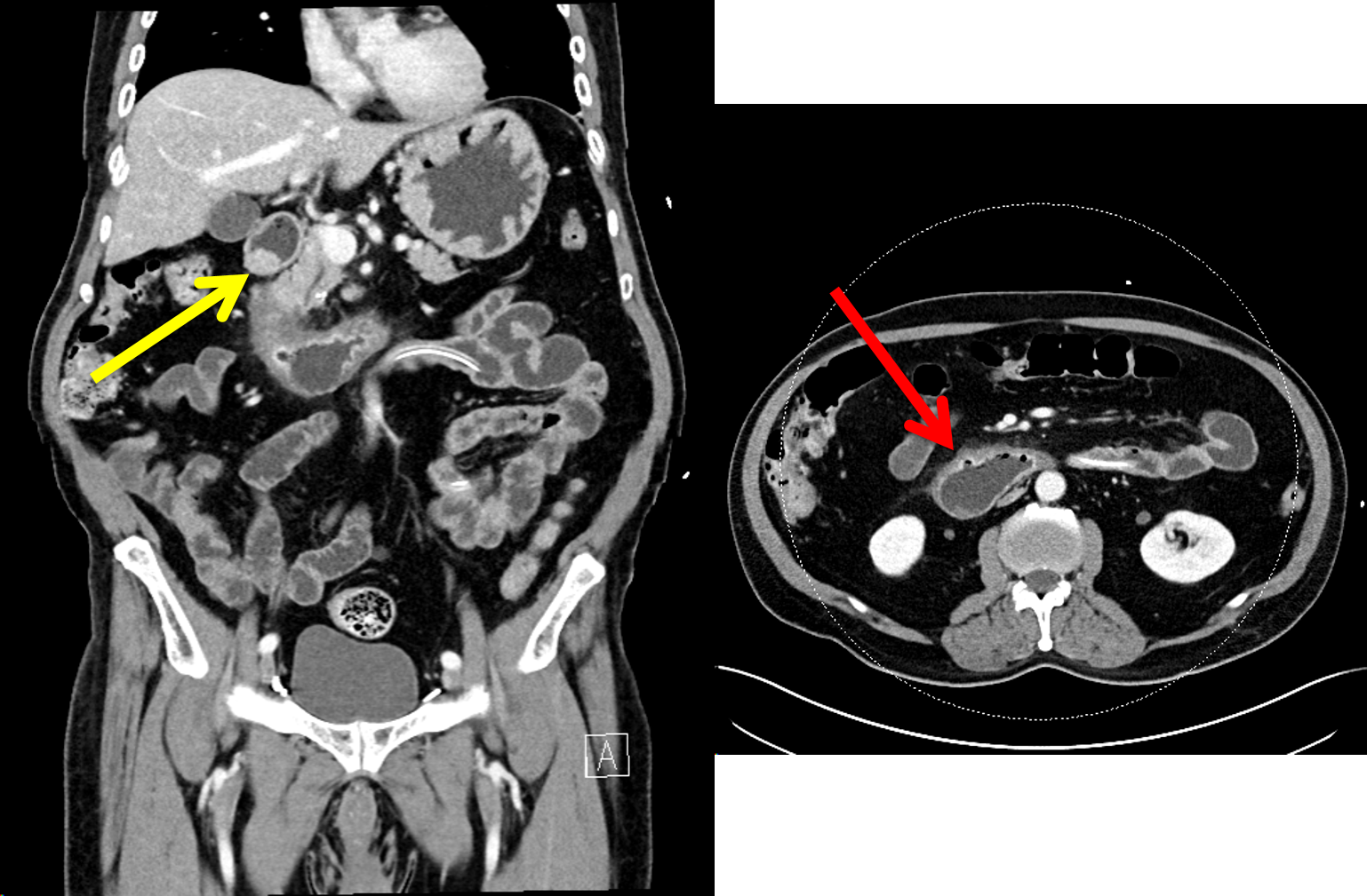 Duodenal hyperemia and ulcers (red arrow). There is a mass in the duodenum (yellow arrow).