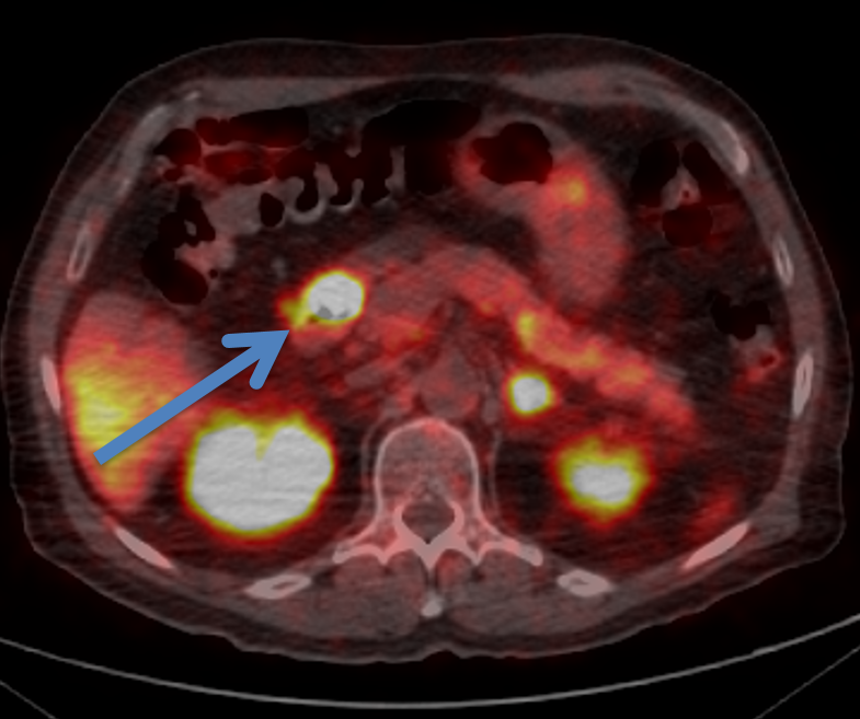 PET Dotatate shows actiity in the duodenal mass (blue arrow).
