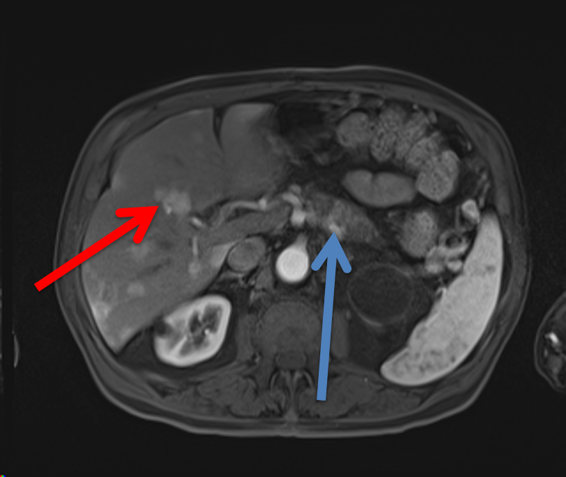 Contrast enhanced T1 arterial phase images show a hypervascular mass in the pancreas (blue arrow) with multiple hypervascular liver metastasis (red arrow).