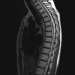 Focal ventral deviation of the thoracic spinal cord through a likely dural defect, concerning for cord herniation.