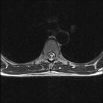 Focal ventral deviation of the thoracic spinal cord through a likely dural defect, concerning for cord herniation.