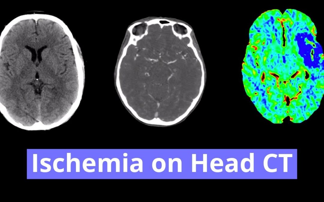 Ischemia on Head CT Video