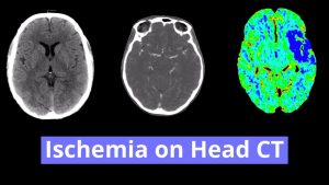 Ischemia on Head CT Video