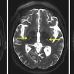 Symmetric T2 signal hyperintensity in the corticospinal tracts in the pons (red arrows), internal capsules (yellow arrows), and centrum semiovale extending to the precentral gyri (blue arrows) in this patient with ALS.