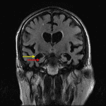 Disproportionate volume loss of the hippocampi and parahippocampal gyri (red arrow) with ex vacuo temporal horn enlargement (yellow arrow) in this patient with Alzheimer disease.