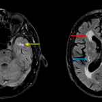 Typical imaging findings for CADASIL: Age-advanced white matter disease (red arrow) with notable involvement of the anterior temporal lobes (yellow arrows) and external capsules and multiple small vessel infarcts involving deep gray structures and deep white matter (blue arrows).