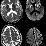 sCJD: Restricted diffusion in the bilateral corpus striatum and to a lesser extent in the thalami (top images) as well as involving the cerebral cortex, moreso in the left hemisphere (bottom images).