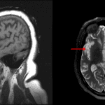 Bilateral frontotemporal atrophy, which is typical for frontotemporal lobar degeneration (FTLD). Asymmetric volume loss in the right cerebral hemisphere with asymmetric ex vacuo enlargement of the right sylvian fissure (red arrow) is typical for the behavioral variant of frontotemporal dementia (bvFTD).