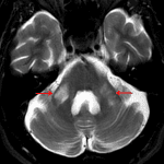 T2 signal hyperintensity in the bilateral middle cerebellar peduncles (red arrows) in this patient with FXTAS.
