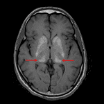 T1 signal hyperintensity in the deep gray structures, notably the pulvinar nuclei of the thalami (red arrows), in this patient with Fabry disease.