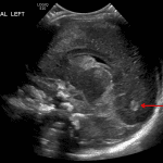 Echogenic material layering in the occipital horn of the left lateral ventricle (red arrow) consistent with intraventricular hemorrhage.