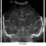 Coronal image in this patient compared with images from different patients imaged at 35 and 42 weeks. Notice how the echogenic sulci become deeper and more numerous with increasing patient age.