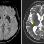 Abnormal hypointense signal in the putamina on susceptibility-weighted imaging (red arrows) and linear T2 hyperintense signal along the periphery of the putamina (yellow arrows) in this patient with MSA-P.