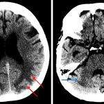 White matter hypoattenuation in the bilateral parietooccipital regions (red arrows) and more subtly in the cerebellar hemispheres (blue arrows), which results in accentuated gray-white differentiation relative to the frontal and temporal lobes.