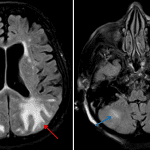 FLAIR sequence from a subsequent brain MRI in this patient shows white matter signal hyperintensity in the parietooccipital regions (red arrows) and cerebellar hemispheres (blue arrows) corresponding with the areas of hypoattenuation on CT.