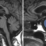 Decreased midbrain to pons area ratio in this patient with PSP, which is calculated by dividing the midbrain area (yellow) by the pons area (blue) on a midline sagittal view.