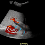 Markedly decreased flow within the main and right portal veins on power Doppler analysis (blue arrows), consistent with near-occlusive thrombosis.